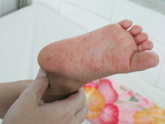 Bệnh nhi thứ hai tử vong có thể do bệnh tay chân miệng