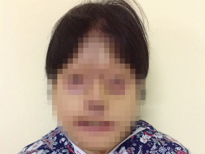 Tái tạo thành công mặt cho bệnh nhân bị tạt axít