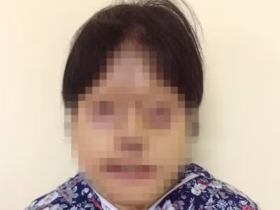 Tái tạo thành công mặt cho bệnh nhân bị tạt axít