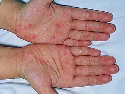 Cứu sống bệnh nhi tay chân miệng thể nặng nhất