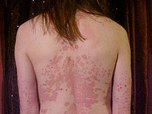 Toàn thân mọc vẩy sau một đêm thức trắng