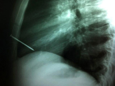 Đinh 8 cm đâm vào tim vẫn sống