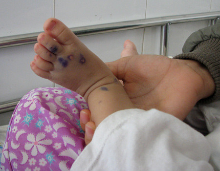 Bệnh tay chân miệng tăng nhanh