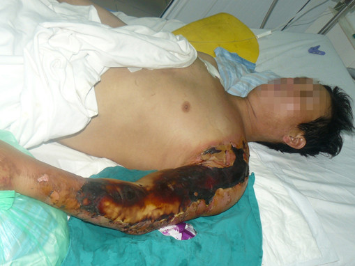 Cách nào phòng vi khuẩn ăn thịt người?