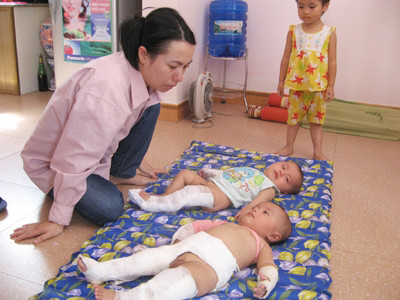 Đập lợn đất giúp đỡ cặp song sinh xương thủy tinh