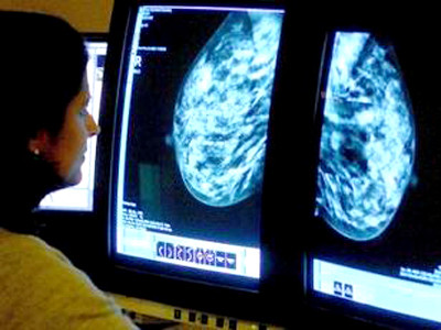 Ung thư vú ủ bệnh từ trước 11 tuổi