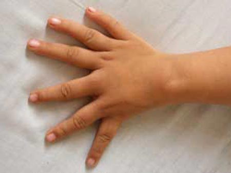 Tay 6 ngón bị từ chối thi bằng lái xe