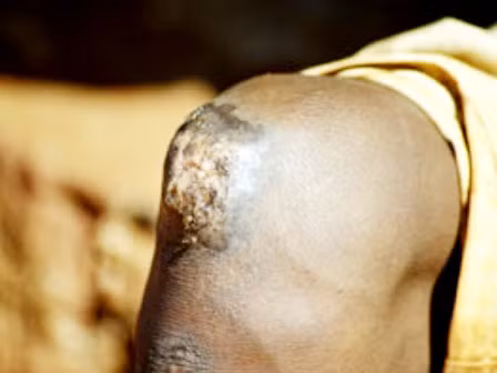 Săn bọ chét gây mục ruỗng cơ thể ở Việt Nam