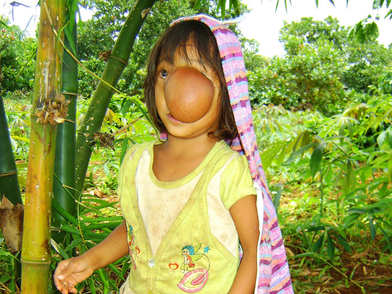 Phẫu thuật thành công ca thoát vị não hiếm gặp