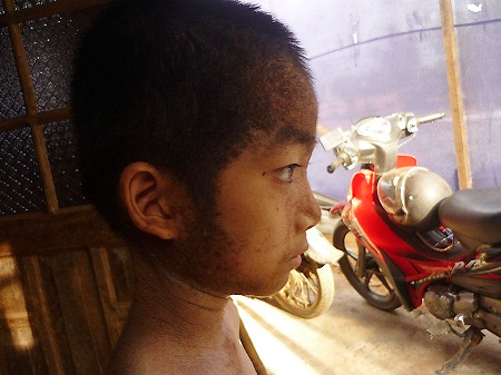 Bé trai 'tí hon' mọc sừng khắp người