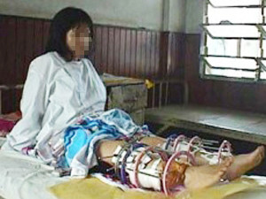 Một bệnh nhân đang trong quá trình thực hiện kéo dài chân (ảnh minh họa)