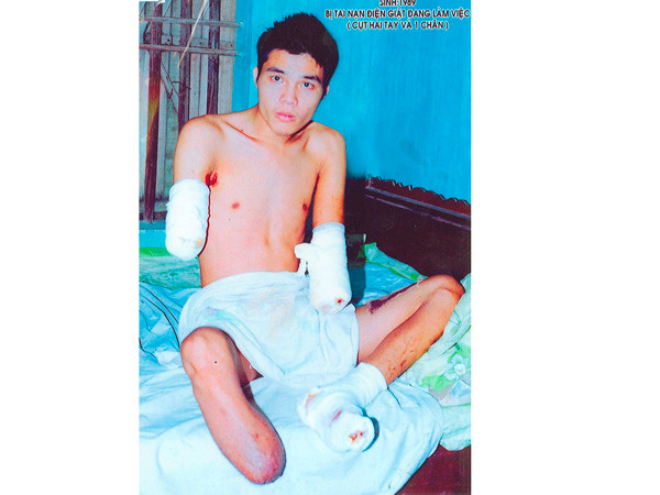 Một thanh niên bị tai nạn cụt hai tay, một chân