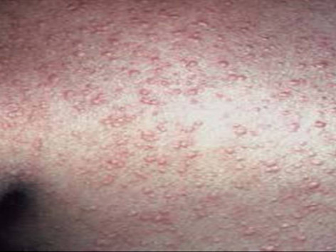 Thay đổi thời tiết, bệnh mề đay xuất hiện