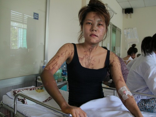 Nữ lễ tân nhà hàng bị tạt axit dã man