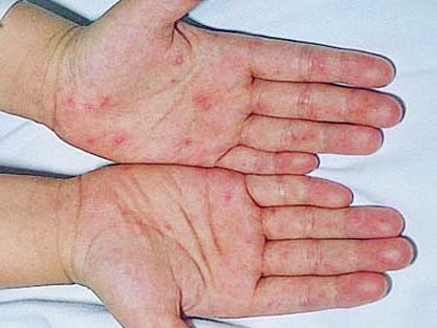 Sáu tháng, 13.000 trường hợp mắc bệnh chân-tay-miệng