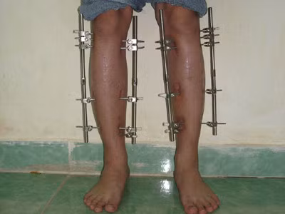 Kéo dài chân một cm mất 25 ngày