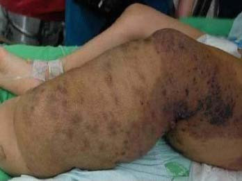 Em bé mắc bệnh chân voi hiếm gặp được phẫu thuật thành công