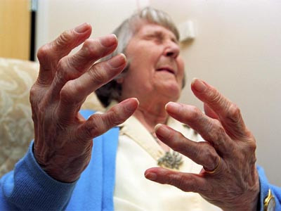 Đừng để tàn phế vì viêm khớp dạng thấp!