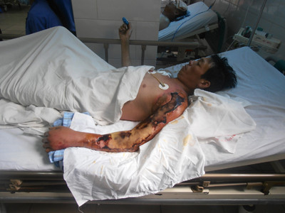 Mắc bệnh hiếm gặp từ vi khuẩn dưới nước