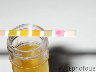 Thử nước tiểu phát hiện loãng xương và ung thư xương