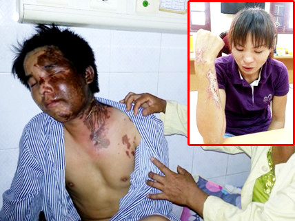 Anh Chỉnh tại Viện bỏng Quốc gia và người đàn bà ghen tuông mù quáng (ảnh nhỏ)