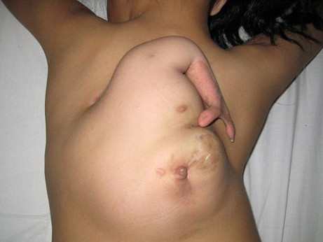 Tay mọc... trên lưng