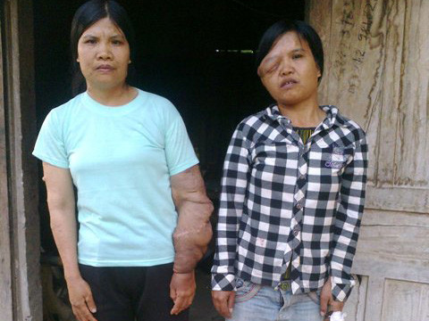 Nỗi đau chị em mang thân hình 'quỷ ám'