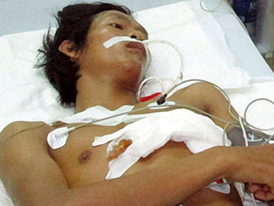 Nhậu say, múa dao tự đâm xuyên tim