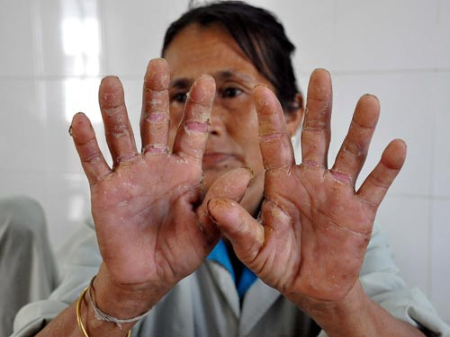 Hai vợ chồng nghi mắc ‘bệnh lạ’ ở Quảng Ngãi