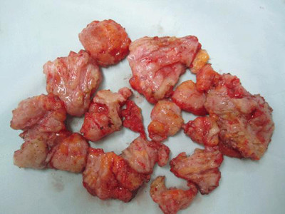 Nam nhi suýt chết vì bơm ngực, độn mông