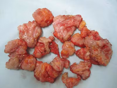 Nam nhi suýt chết vì bơm ngực, độn mông