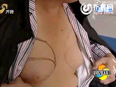 Ngực to như phụ nữ vì uống thuốc chữa vô sinh