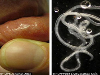 Tiến sĩ tự gắp ấu trùng giun từ niêm mạc môi mình