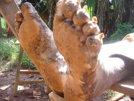 Căn bệnh quái ác biến người thành… thây ma sống