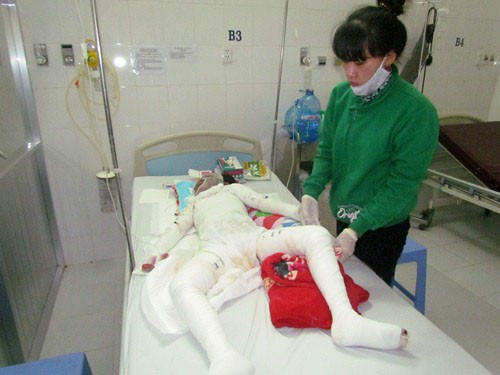 Cháu Thủy đang nguy kịch vì bị cháy toàn thân