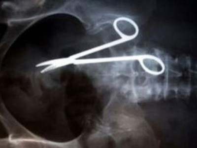 Bỏ quên kéo dài 8cm trong bụng suốt ba năm