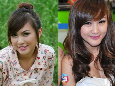 Những ca mổ kinh hoàng của Hot girl suýt mất... cằm vì làm đẹp