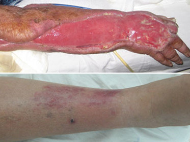 Vết thương nhỏ có thể gây chết người