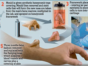 Chiếc mũi được tái tạo trên... cánh tay của người đàn ông 56 tuổi