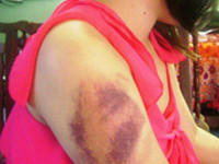 Nữ sinh tố cáo bị cha hành hung dã man