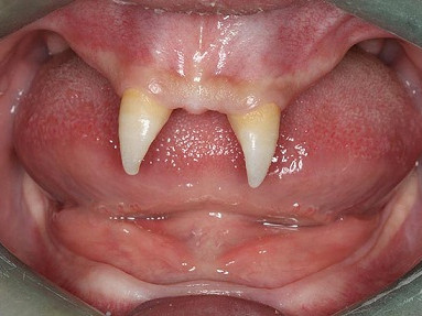 Cậu bé mọc răng như ma cà rồng