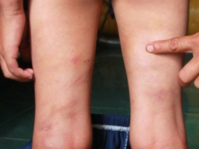 Bé 10 tuổi bị mẹ kế bạo hành suốt ba năm