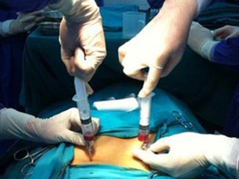 Chi tiền tỷ tiêm tế bào gốc để hồi xuân