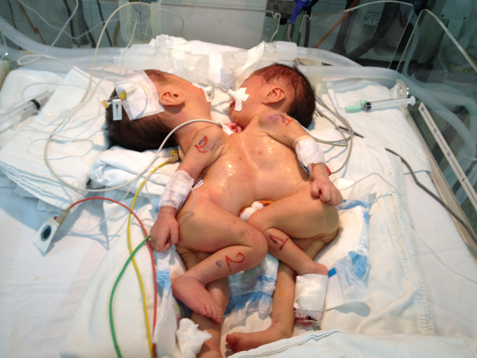 Nghẹn lòng trước cặp song sinh dính liền ngực