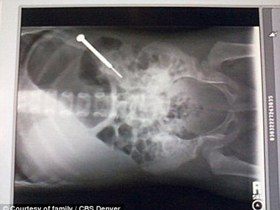 Bé gái 2 tuổi nuốt tua vít 9cm