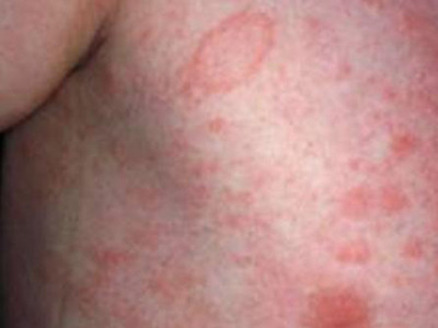 Điều trị bệnh vẩy da- Đừng quên các kem dược liệu bôi ngoài