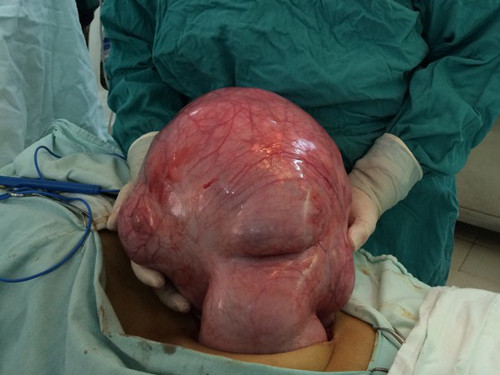 Cắt u xơ khổng lồ nặng gần 10kg