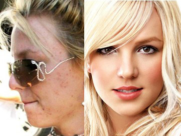 Trị mụn rẻ bất ngờ với sao Hollywood