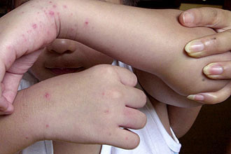 Hướng dẫn mới chẩn đoán, điều trị bệnh tay chân miệng