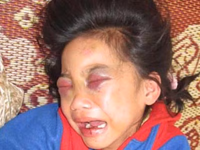 Kiến nghị tước quyền bố mẹ của vợ chồng đánh con nuôi